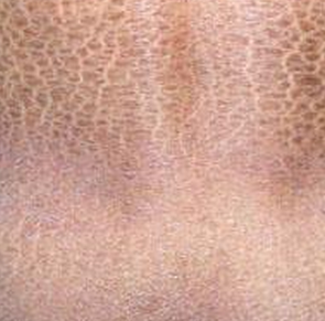 鱼鳞病2 鱼鳞病2