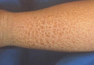 鱼鳞病3 鱼鳞病3